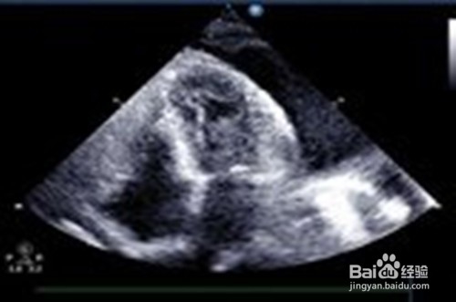 胸膜炎与脓胸有哪些症状？