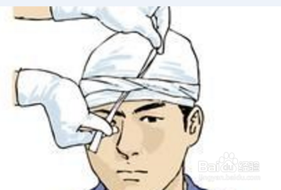 头部缝针后要注意些什么