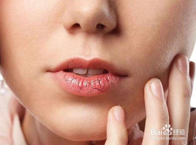 如何防止嘴唇干裂