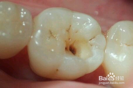 口臭产生的几大重要原因