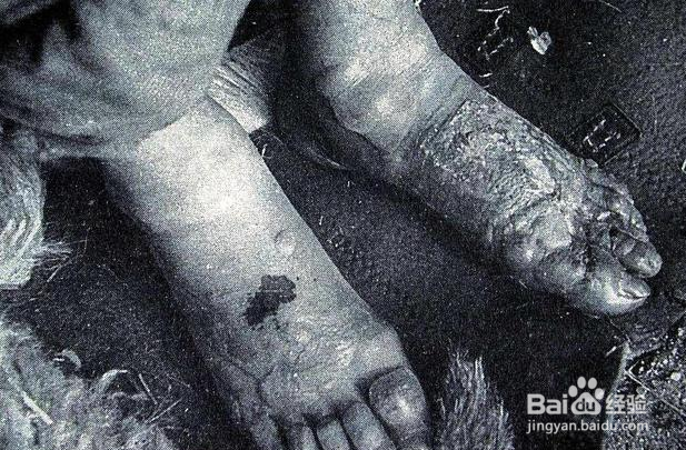 天气越冷越容易长冻疮的原因是蚂蚁庄园答案