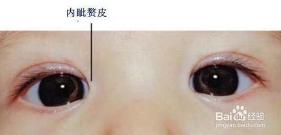 孩子“对眼”如何干预