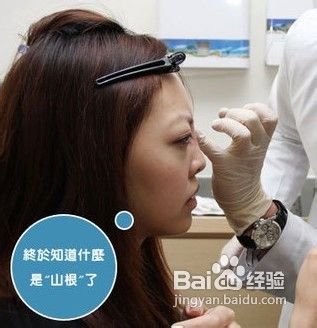 全面解析隆鼻方法[14]假体隆鼻效果好吗