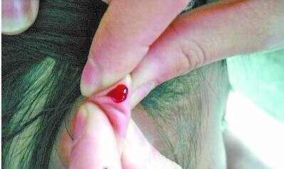 介绍两个防治高血压的中医外治法