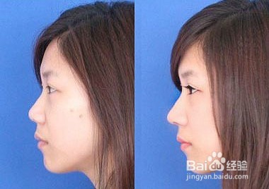 隆鼻手术注意事项