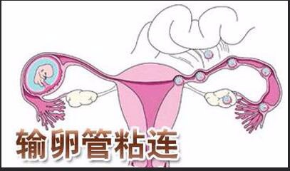 宫外孕常见病因