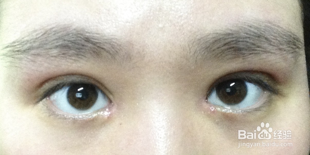 开眼角后常常无刺激下流眼泪怎么办？