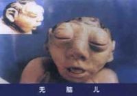 如何预防胎儿先天性畸形