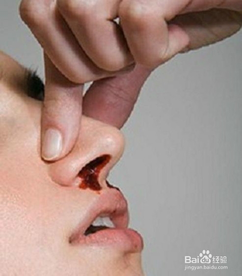 流鼻血了怎么办？