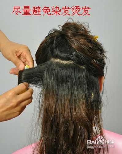 脱发应该怎么办