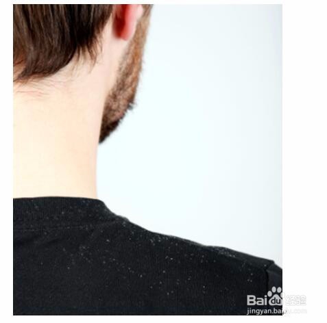 知道怎么去头皮屑,职场才能“青云直上”