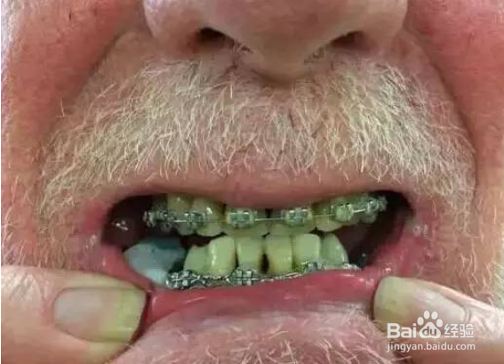 矫正牙齿的错误认识