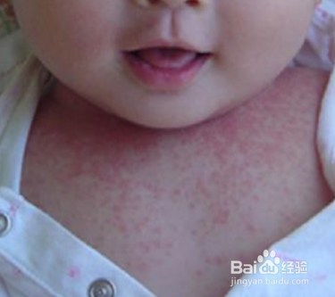 炎炎夏日如何预防宝宝长痱子?