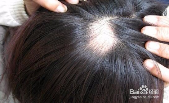 掉头发很厉害？学会这些从此告别掉发！