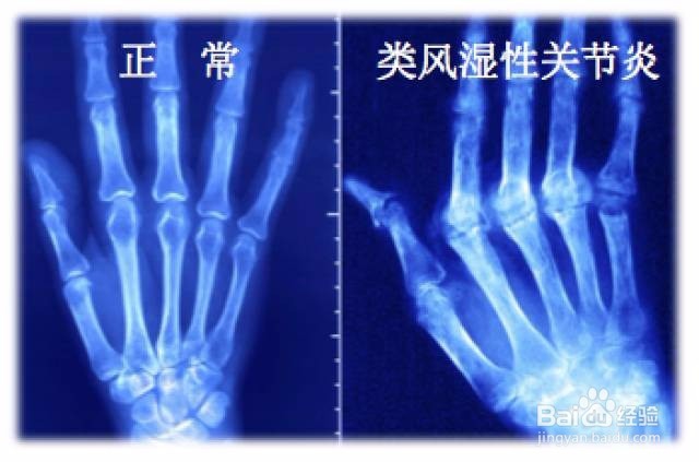 风湿和类风湿的区别有哪些如何区分