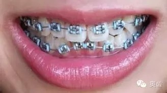 牙齿矫正的全部流程