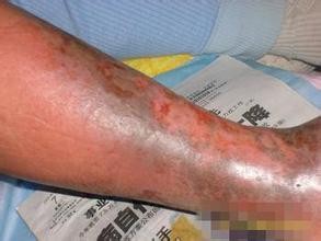 静脉曲张简介、预防、治疗