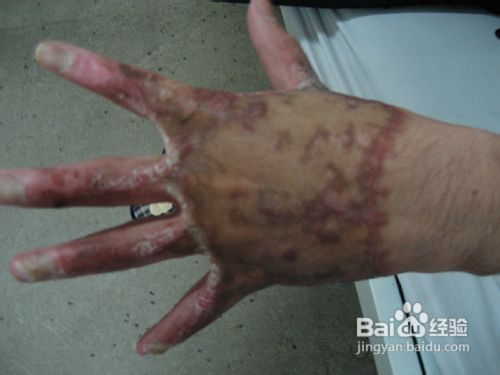 如何去除烫伤疤痕