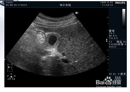 胆道系统几种常见疾病的影像图片。