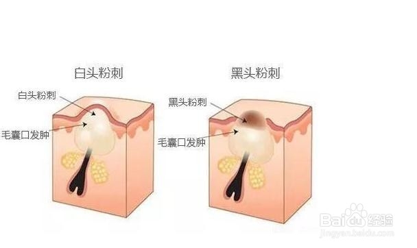 油性皮肤毛孔粗大怎么办