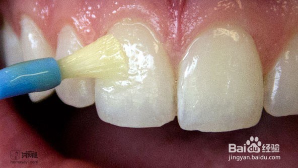 儿童蛀牙奶瓶龋怎么办?