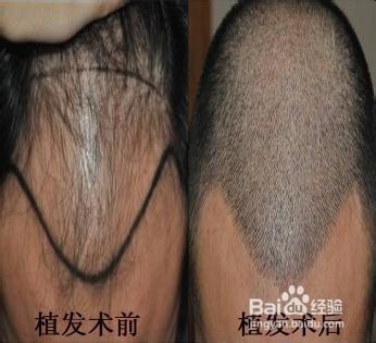 植发手术常见问题介绍