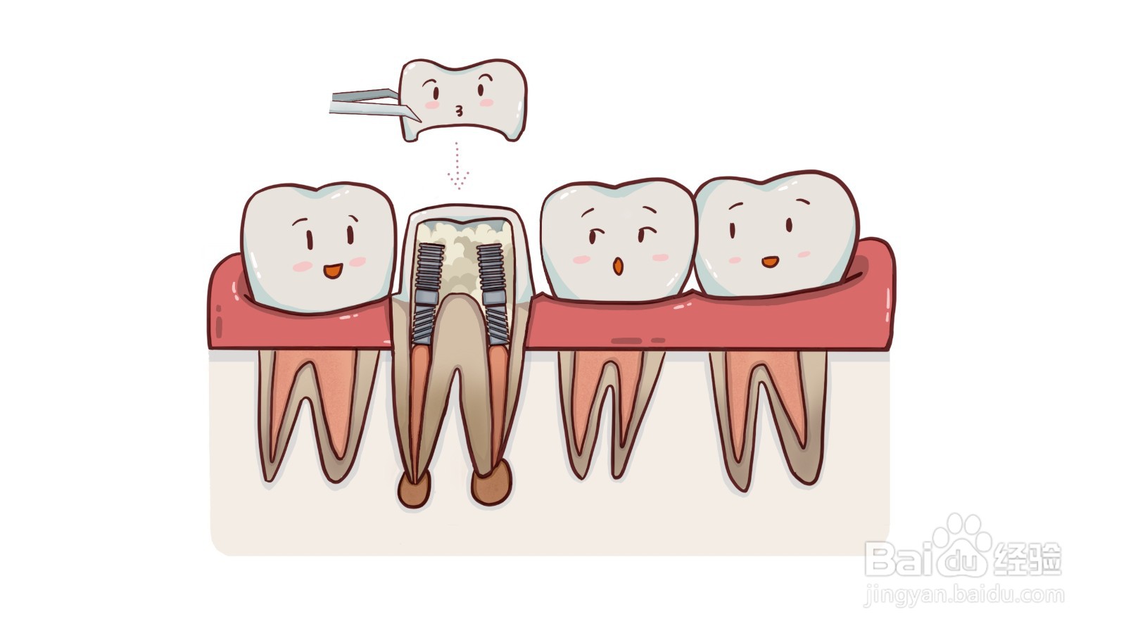 什么是根管治疗？有什么危害？