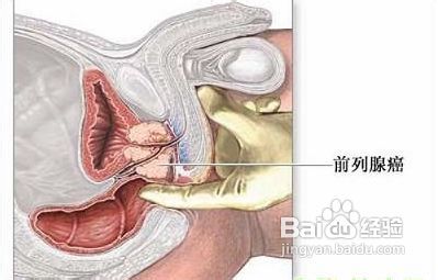 患有前列腺癌吃什么比较好?