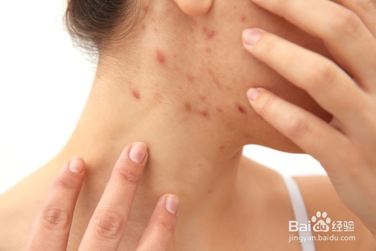 疖肿的治疗方法及疖肿用什么药