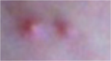 可以治青春痘的办法