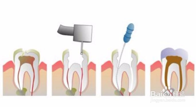 蛀牙根管治疗怎么回事？根管治疗流程