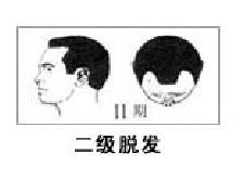 男性流花植发有哪些优点和特点?