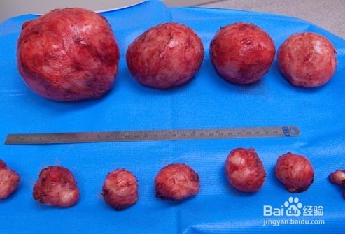 使用偏方后子宫肌瘤消失