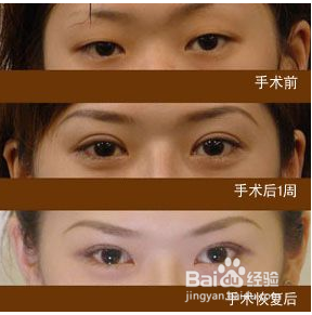 请问做开眼角手术多少钱