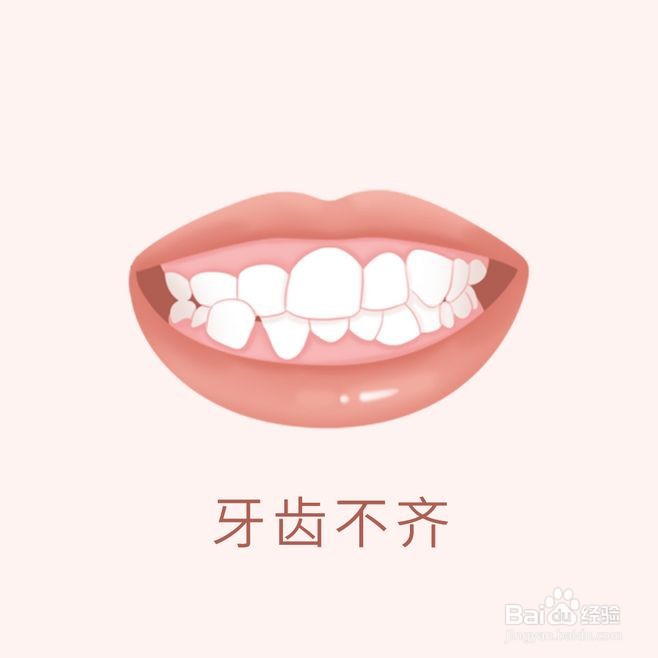 牙齿矫正类型