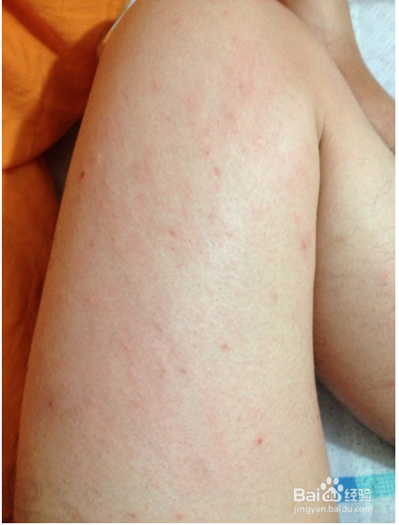 冬天腿部干痒怎么办