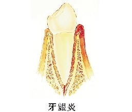 自己就可以判断有没有牙周病