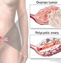 多囊卵巢综合症吧