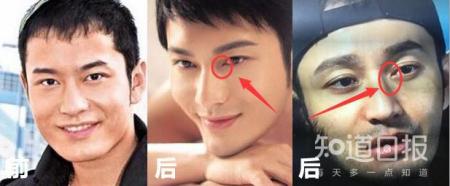 开眼角手术后留下明显疤痕，该怎么办