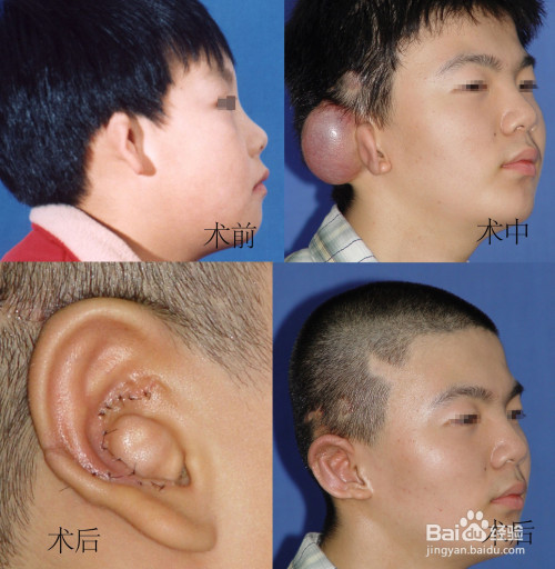 耳朵整形:扩张全包法耳再造手术方法步骤