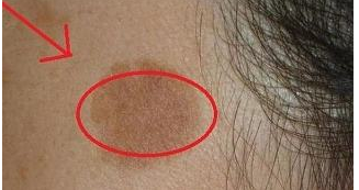 脸上容易长斑是由坏习惯引起的吗