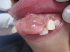 关于洗牙的那些事