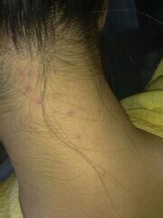 如何防止皮肤长痘痘