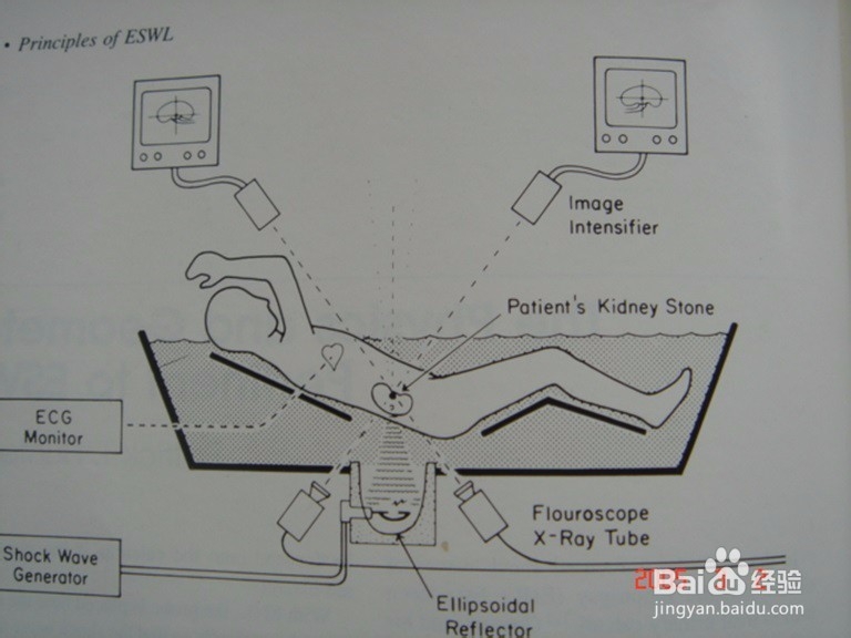 如何认识“肾结石”