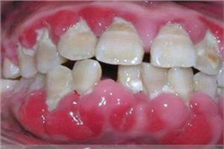 做了纯钛烤瓷牙后护理可以延长使用寿命