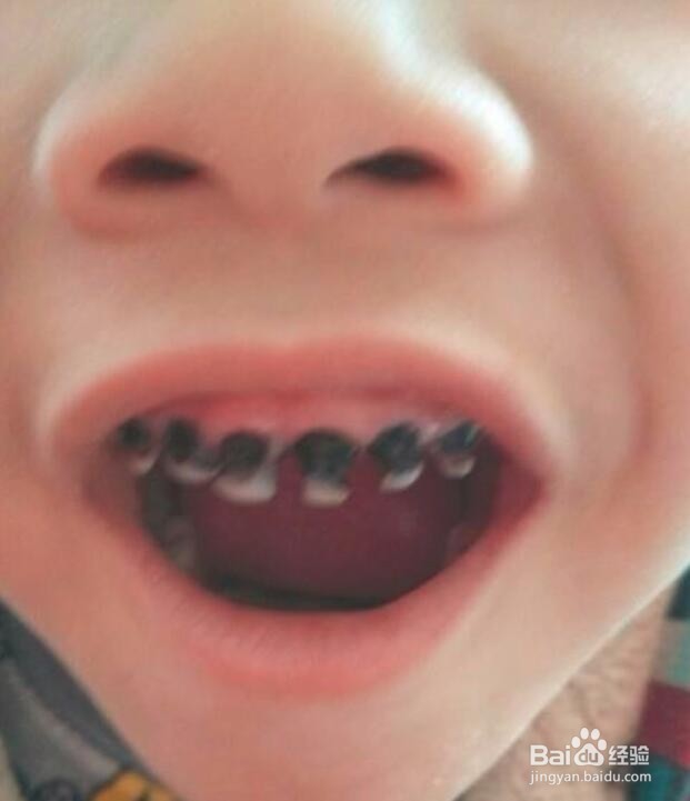<b>幼儿牙齿全部烂了怎么办？了解一下</b>