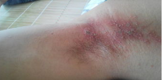 腋下湿疹症状有哪些_治疗方法 【用药大全】