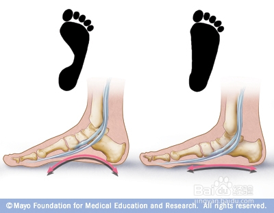 新生儿为什么都是扁平足？