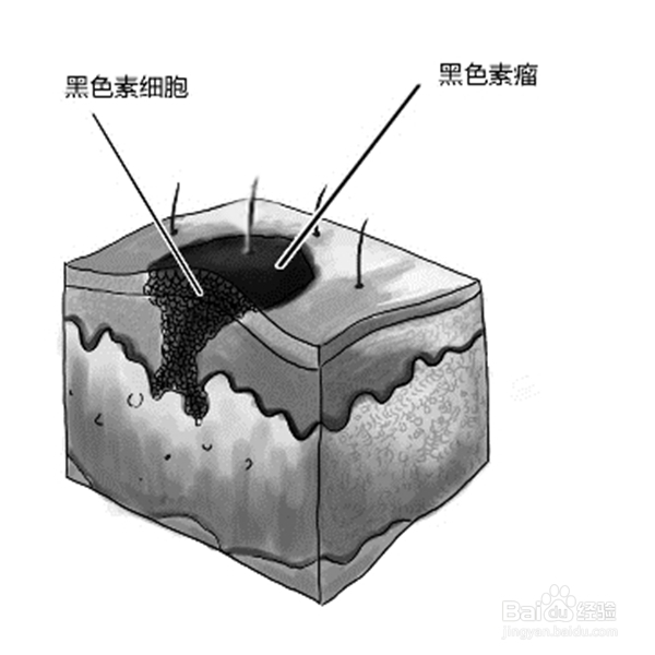 脱毛方式与脱毛注意事项