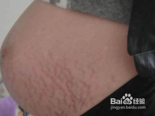 出现妊娠纹的原因